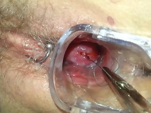 Mirena Spirale usuwanie ziehen IUD IUP entfernen